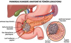 ABD Pankreas Kanserinde Çığır Açıcı Tedaviyi Onayladı