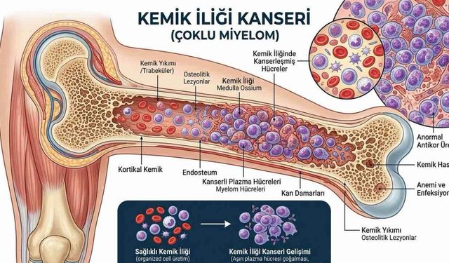Kemik İliği Kanseri Vejetaryenlerde Daha Az Görülüyor
