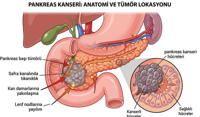 ABD Pankreas Kanserinde Çığır Açıcı Tedaviyi Onayladı