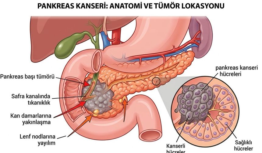 ABD Pankreas Kanserinde Çığır Açıcı Tedaviyi Onayladı